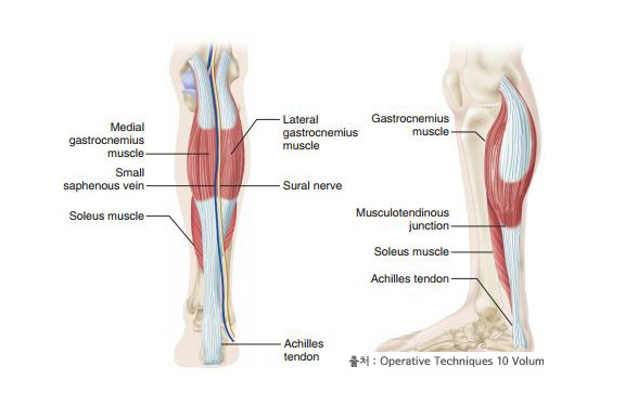 아킬레스 건염, 문제는 나에게 있었어